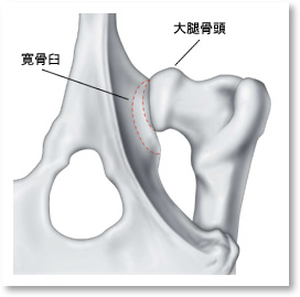 CHDにより亜脱臼を示す股関節（背側）