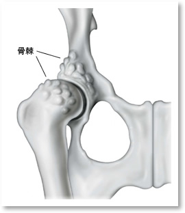 CHDにより変形し凹凸（骨棘）が形成された股関節（腹側）