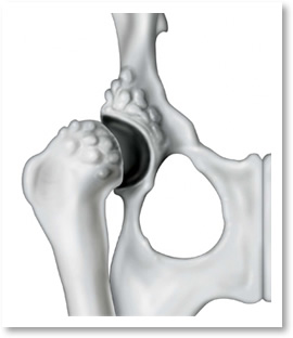 CHDにより亜脱臼、変形し凹凸（骨棘）が形成された股関節（腹側）