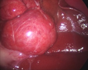 肝臓の腫瘤
